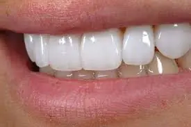dientes blancos, recetas, blanqueamiento